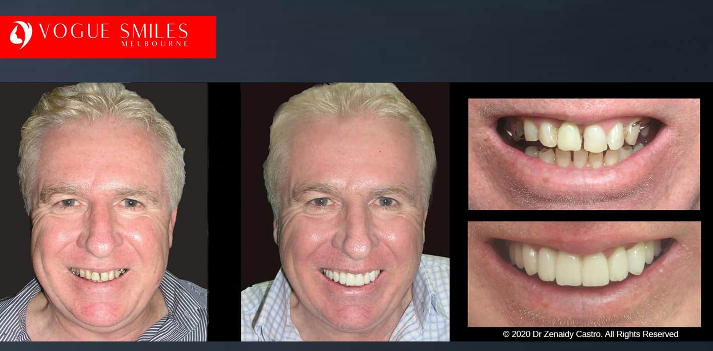 COSMETIC DENTIST NEAR ME - Before and After Cosmetic Treatment Gallery Melbourne CBD