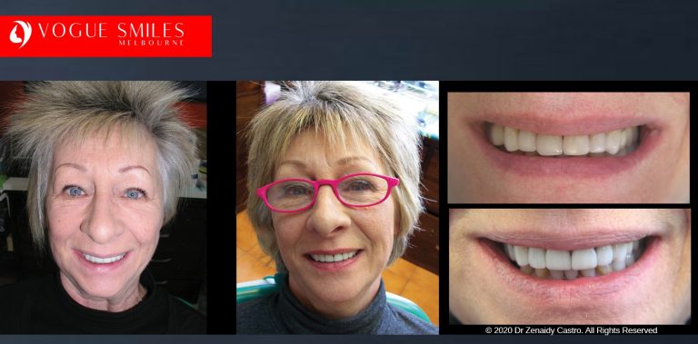 COSMETIC DENTIST NEAR ME - Before and After Cosmetic Treatment Gallery Melbourne CBD