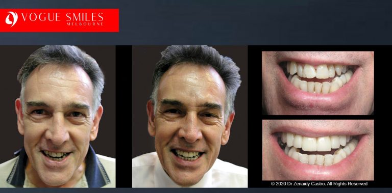 COSMETIC DENTIST NEAR ME - Before and After Cosmetic Treatment Gallery Melbourne CBD