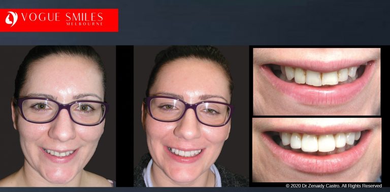Dental Bonding Before and After | Composite Veneers Smile Gallery Melbourne CBD