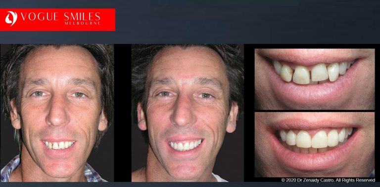 Dental Bonding Before and After | Composite Veneers Smile Gallery Melbourne CBD