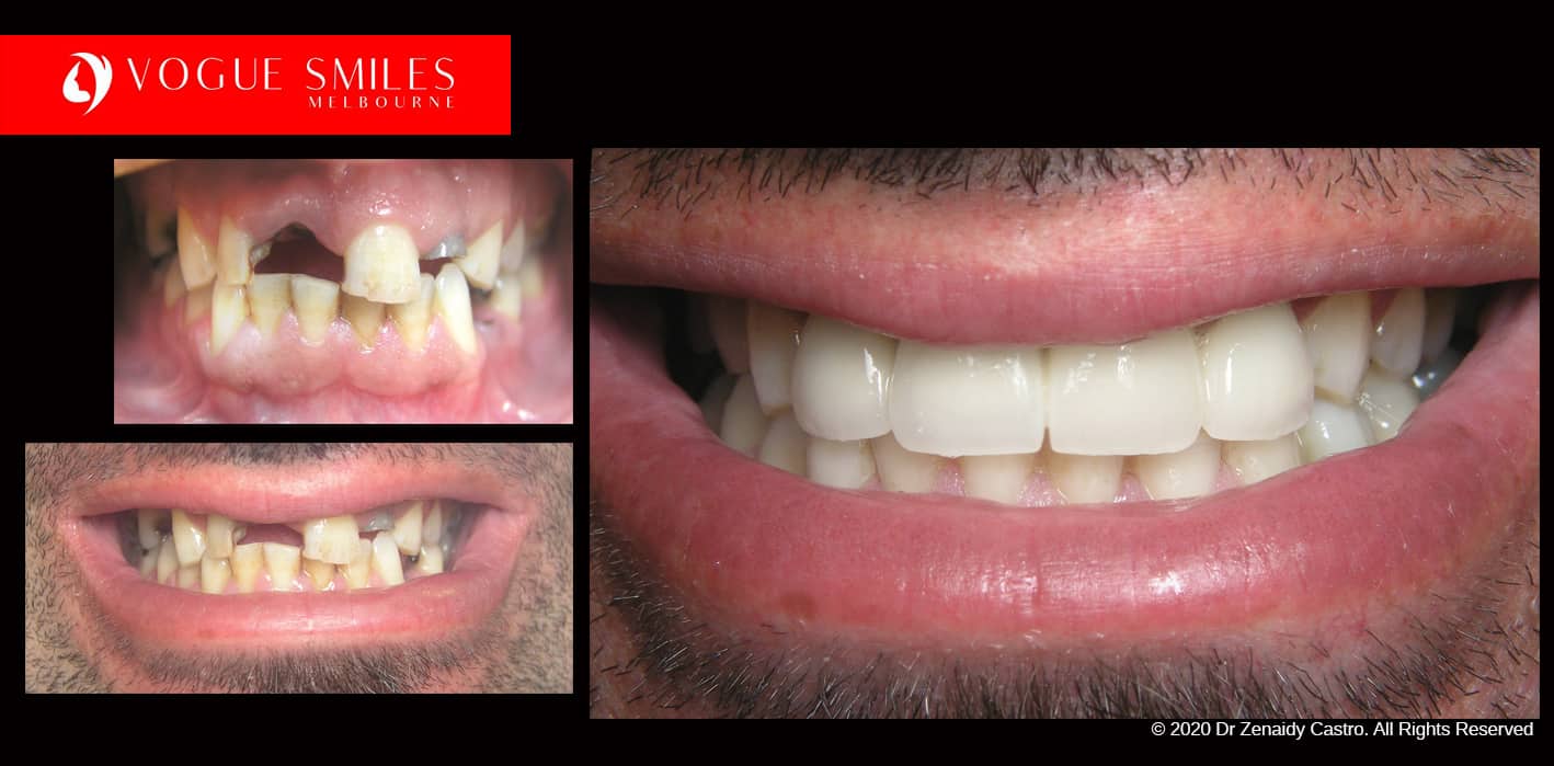 Full Mouth Reconstruction- Full Dental Reconstruction - Mouth Rehabilitation & Implants -dental makeovers Melbourne Australia, extreme smile makeover Melbourne Before and after