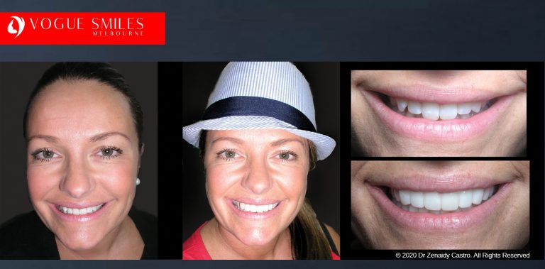 Affordable Cosmetic Dentistry Before & After - SNAP ON SMILE MELBOURNE AUSTRALIA