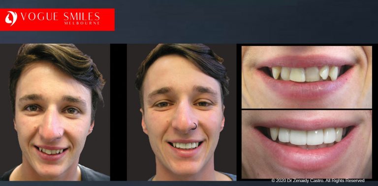Crooked Teeth Before and After Photos - Smile Gallery Melbourne CBD -VOGUE SMILES MELBOURNE