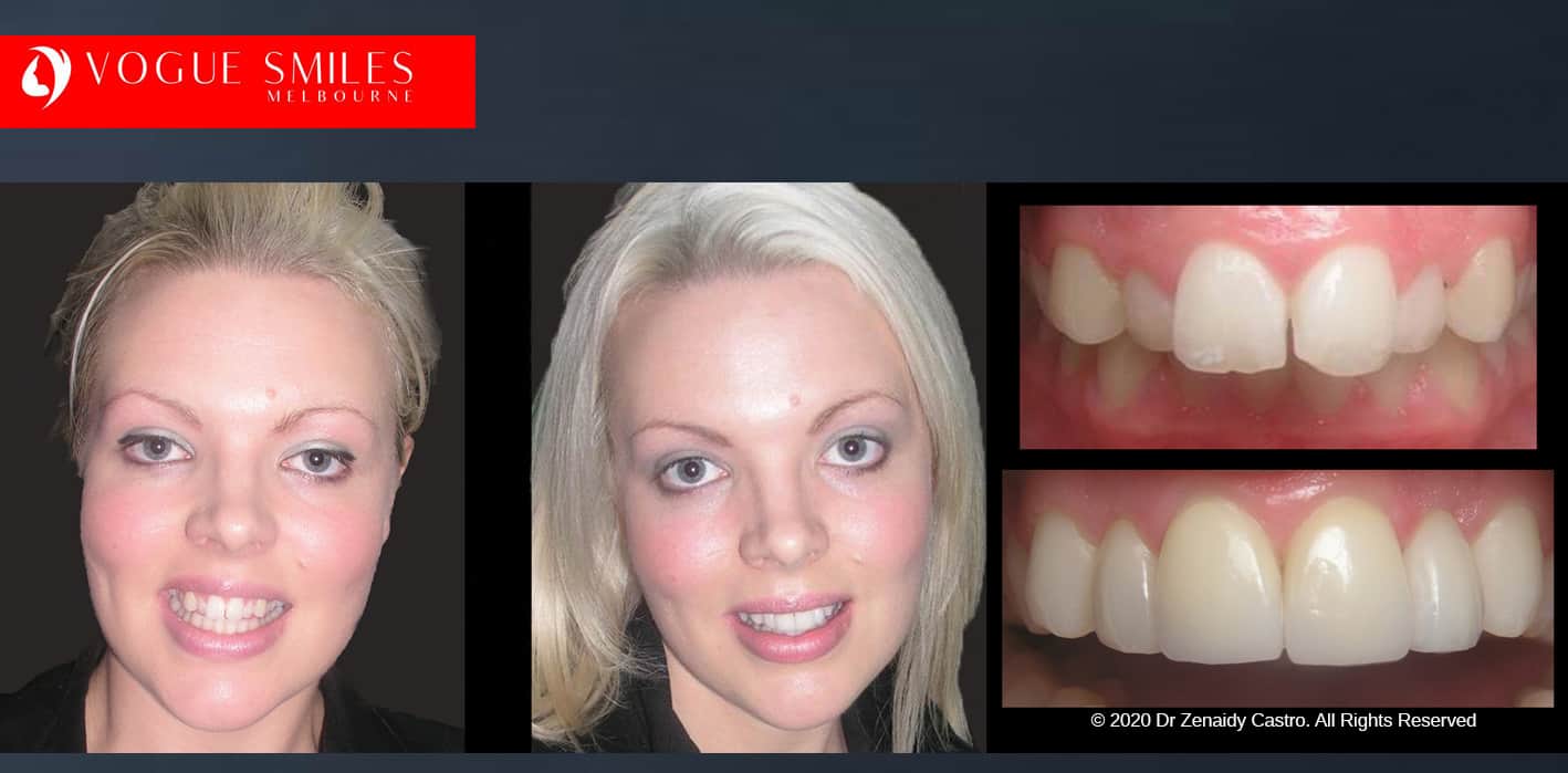 Crooked Teeth Before and After Photos - Smile Gallery Melbourne CBD -VOGUE SMILES MELBOURNE