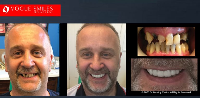 Porcelain Dental Crowns in Melbourne Before and After, Dental Bridges in Melbourne Before and After, Dental Crowns and Dental Bridges Melbourne CBD Before and After