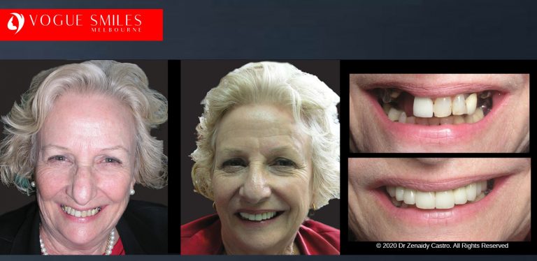 Dr Zenaidy Castro Melbourne's Top Cosmetic Dentist- BEST DENTIST IN MELBOURNE Smile Makeover Before and After Dental Gallery