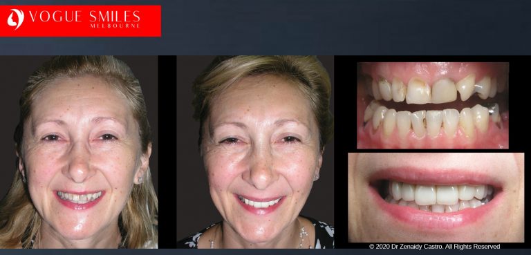 Dr Zenaidy Castro Melbourne's Top Cosmetic Dentist- BEST DENTIST IN MELBOURNE Smile Makeover Before and After Dental Gallery