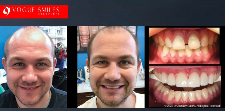VENEERS DENTIST NEAR ME MELBOURNE CBD -DENTAL VENEERS affordable Porcelain Veneers Melbourne CBD