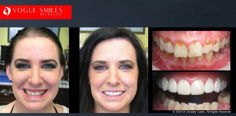 Porcelain Veneers Before and After | Veneers Smile Gallery Melbourne CBD