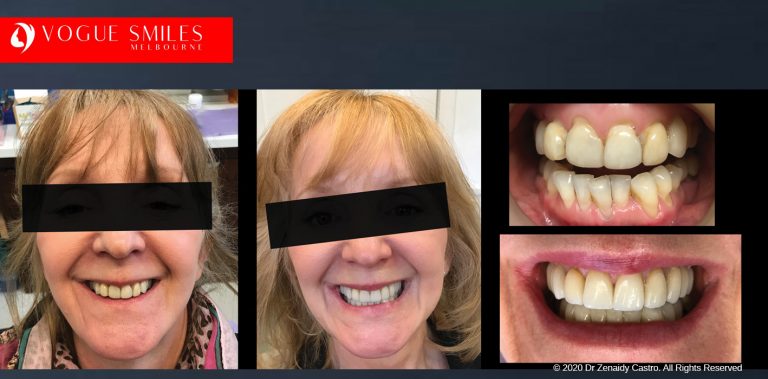Porcelain Veneers Before and After | Veneers Smile Gallery Melbourne CBD
