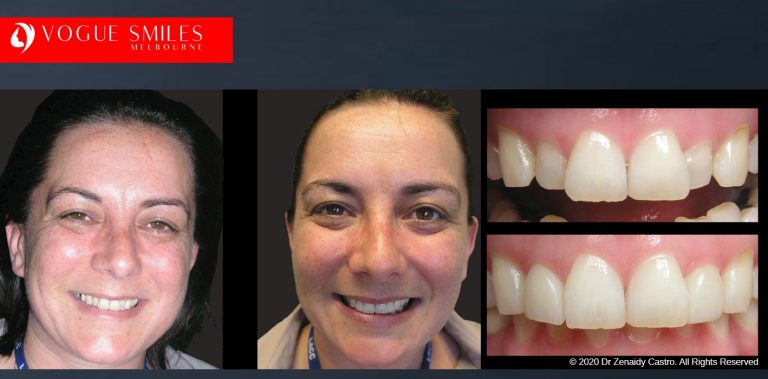Porcelain Veneers Before and After | Veneers Smile Gallery Melbourne CBD
