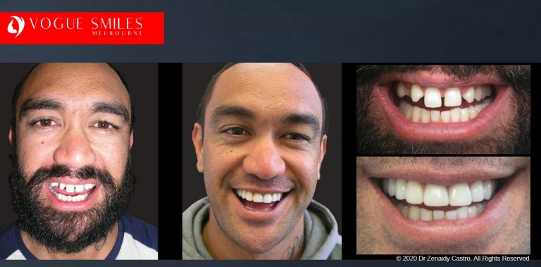 Porcelain Veneers Before and After | Veneers Smile Gallery Melbourne CBD