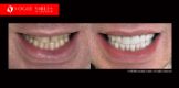 Extreme Smile Makeover Before and After Melbourne, Full Mouth Reconstruction- Full Dental Reconstruction - Mouth Rehabilitation & Implants Before and After Melbourne, close-up smile photo before and after Melbourne
