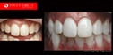 Laser-In-Chair,-in-office-Teeth-Whitening--Melbourne-Dentist--be