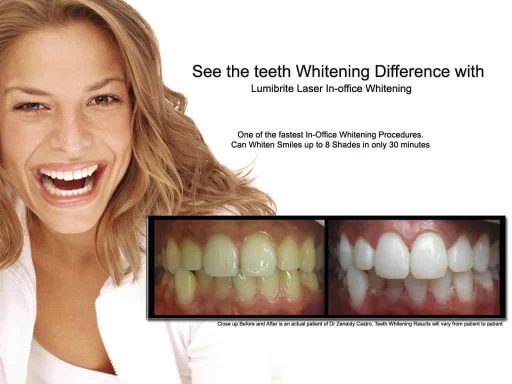 LumiBrite Chairside Whitening System versus Zoom In-Chair Teeth Whitening