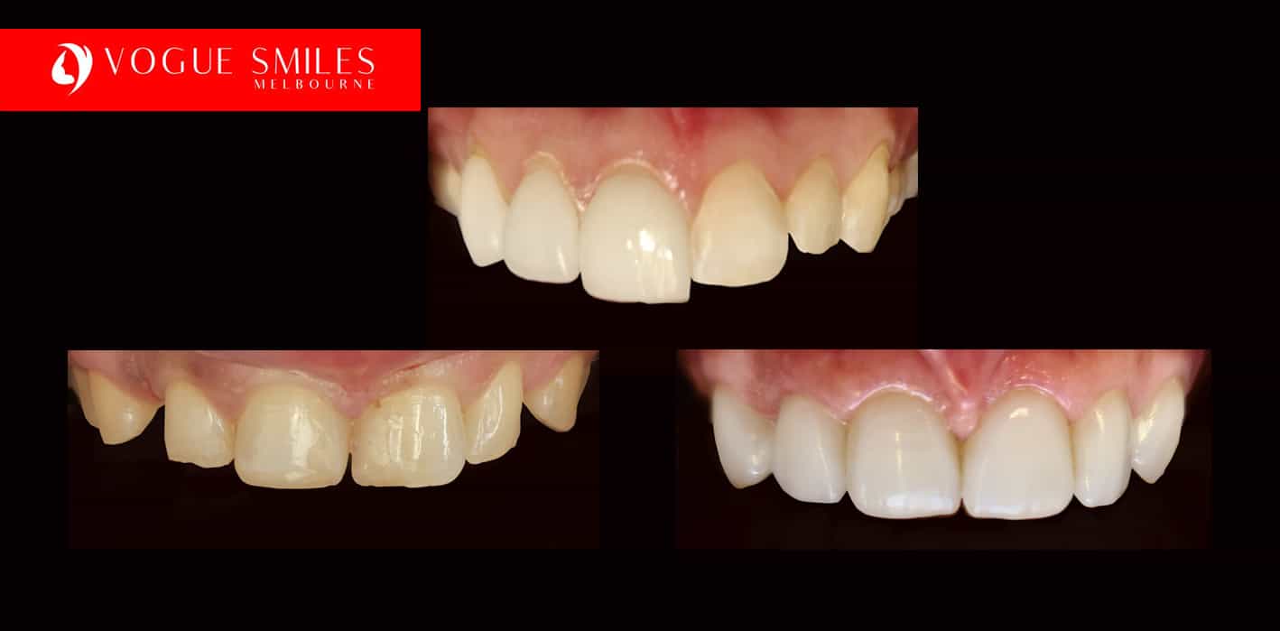 Porcelain Veneer for Small Teeth Melbourne -How Can a Dentist Make My Small Adult Teeth Look Larger and bigger?