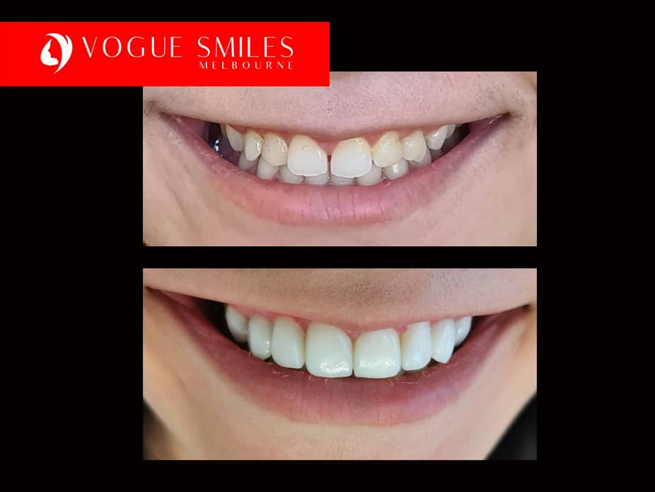 Porcelain Veneer for Small Teeth Melbourne -How Can a Dentist Make My Small Adult Teeth Look Larger and bigger?