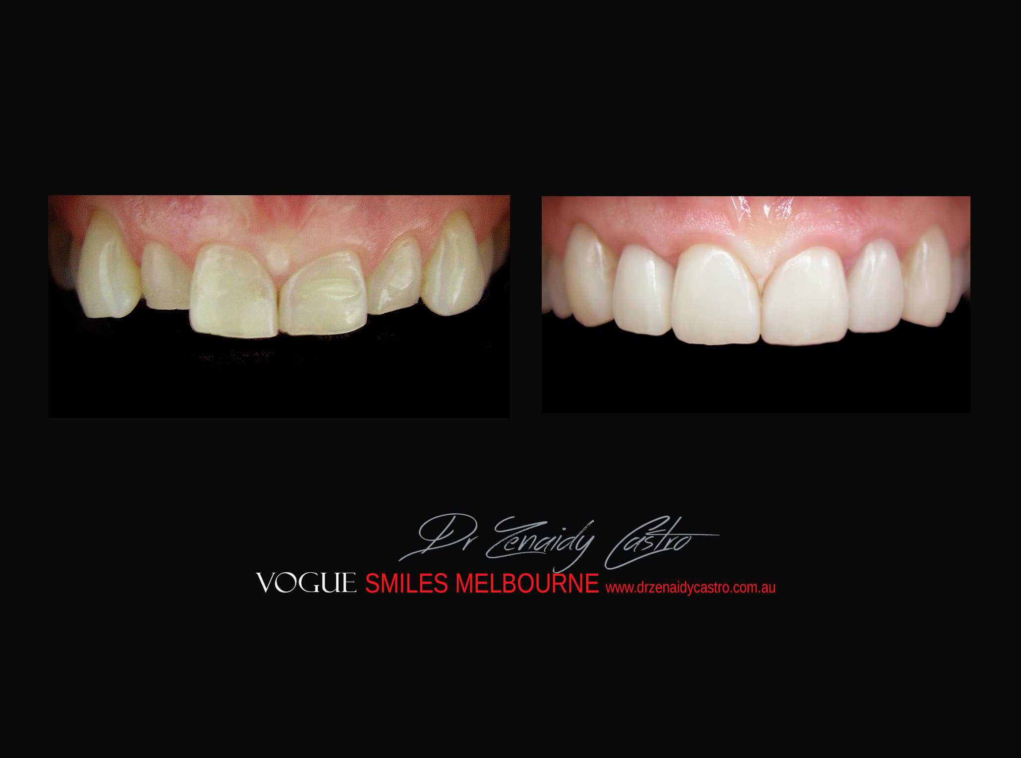 Top Cosmetic Dentist in Melbourne CBD before and after photo case study r39