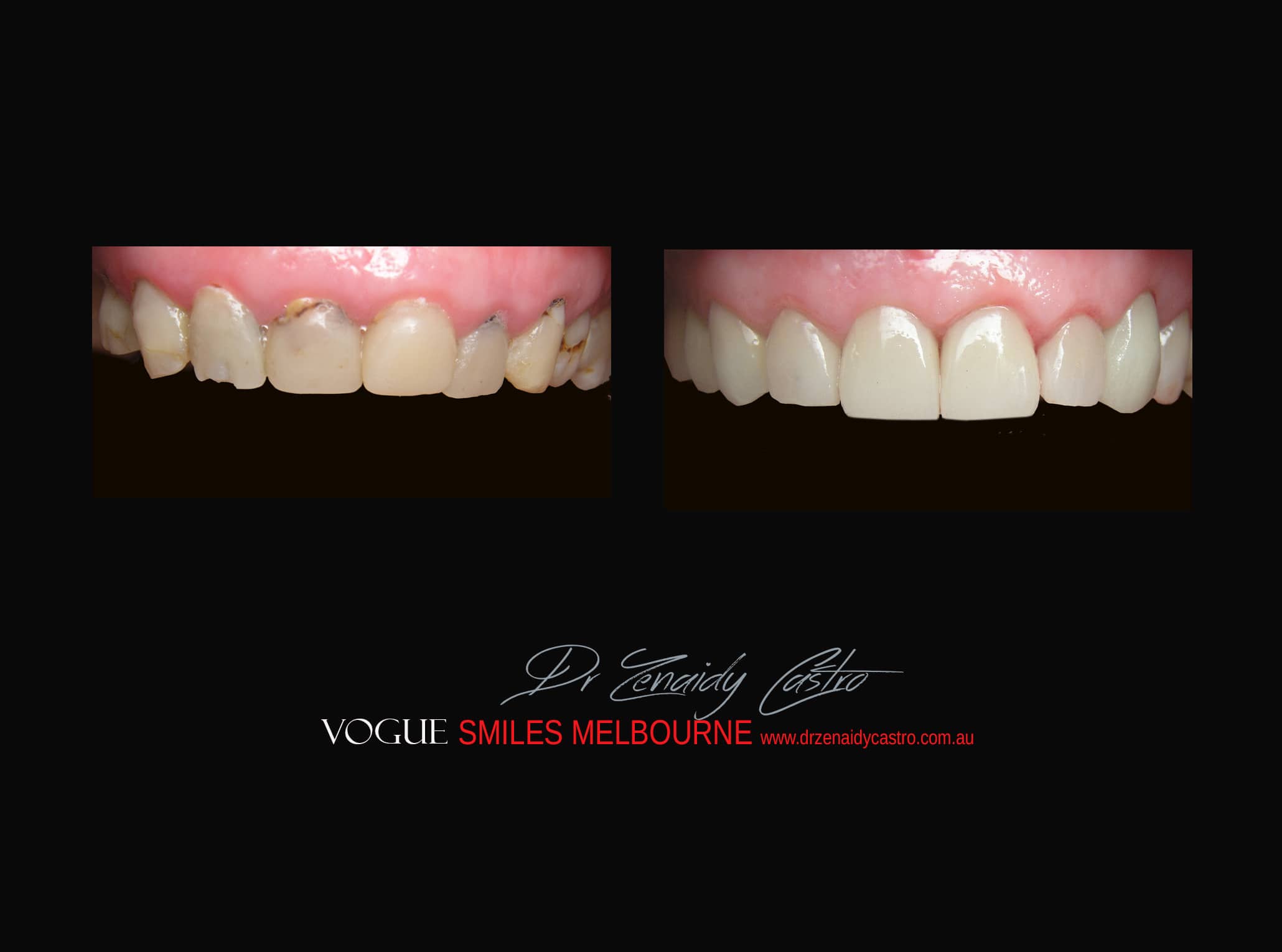 Top Cosmetic Dentist in Melbourne CBD before and after photo case study r12