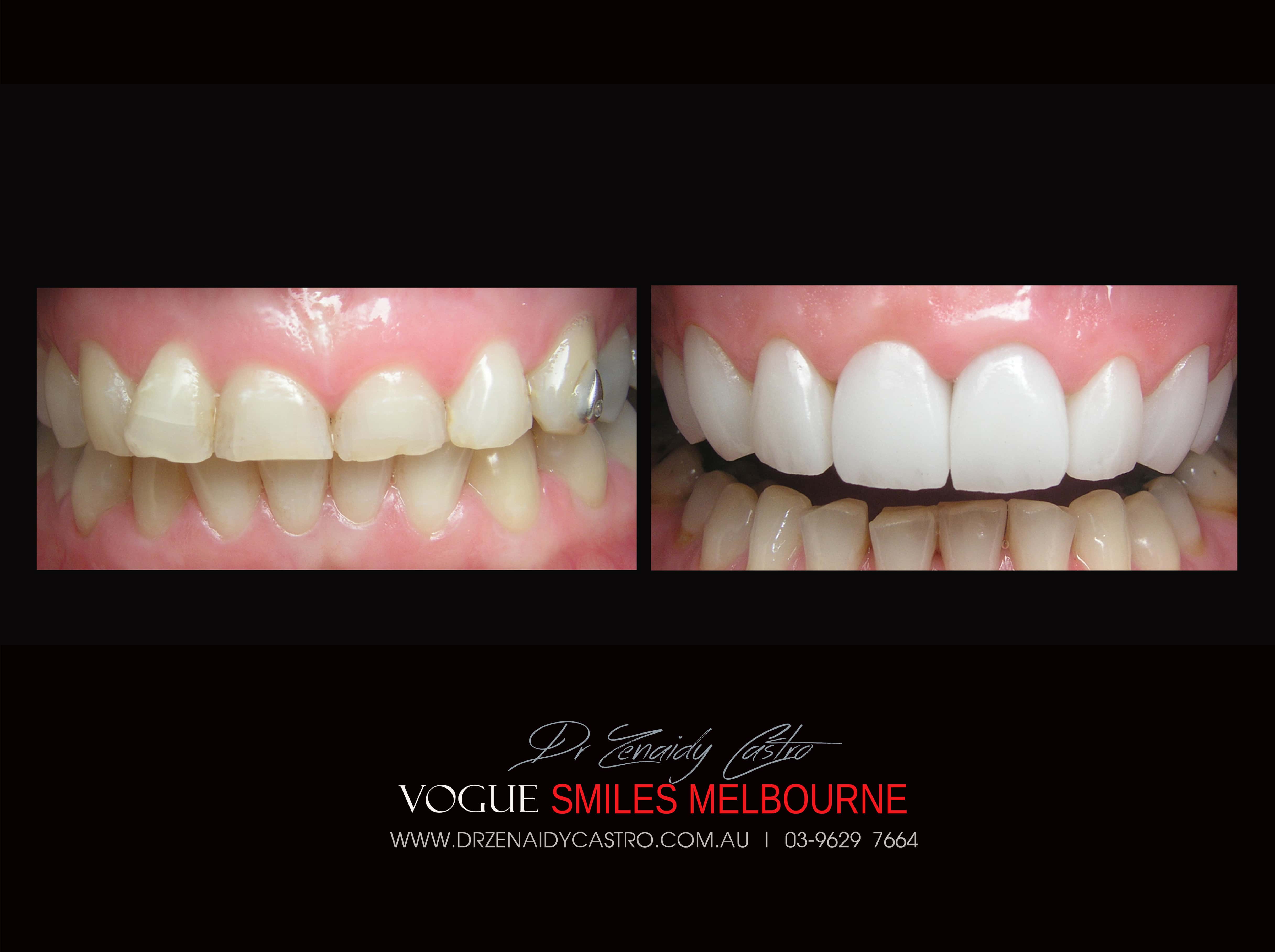 Porcelain Veneer for Short Teeth, Worn down teeth - #1 Porcelain Veneers Melbourne -Top Cosmetic dentist