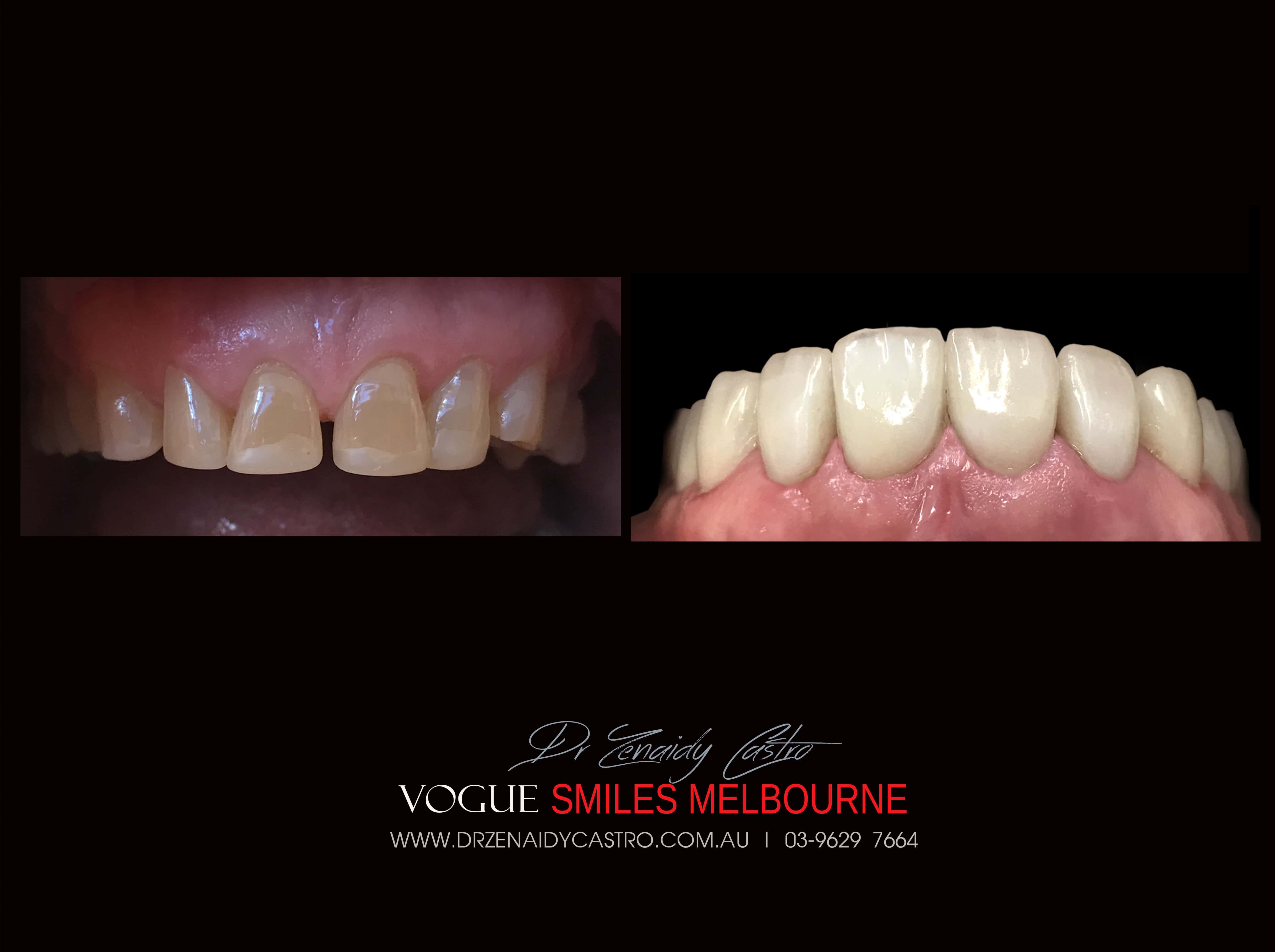 Porcelain Veneer for Short Teeth, Worn down teeth - #1 Porcelain Veneers Melbourne -Top Cosmetic dentist