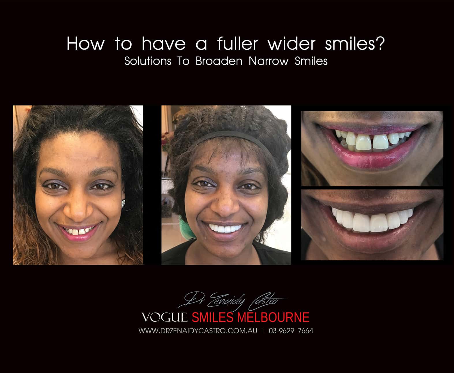 Porcelain Veneer to Widen Smile and Broaden Narrow Smiles for Fuller Smiles