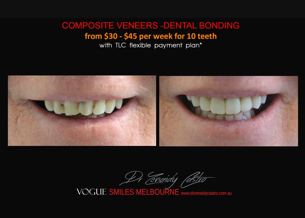 Porcelain Veneer Specials and Packages in Melbourne WITH PREPLESS / NO-PREP OR NO GRINDING