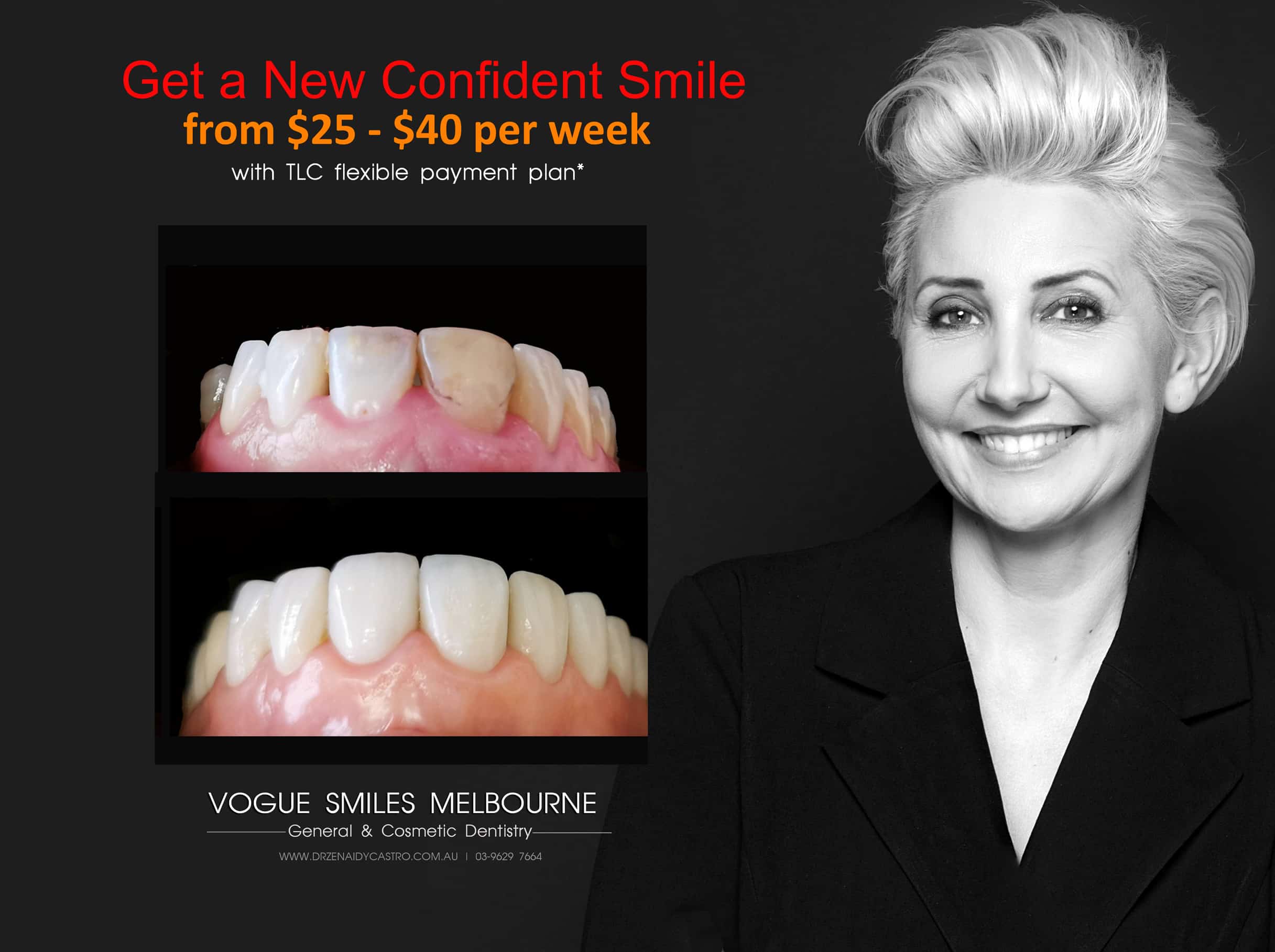 Least Expensive Smile Makeover option in Melbourne - cheapest way to improve smile 