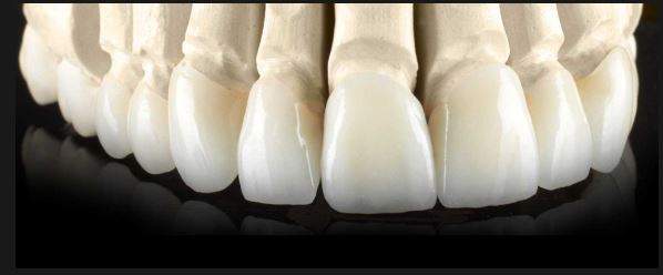 Cost of Dental Crown in Melbourne. How Much Does Dental Crown cost in Melbourne? 