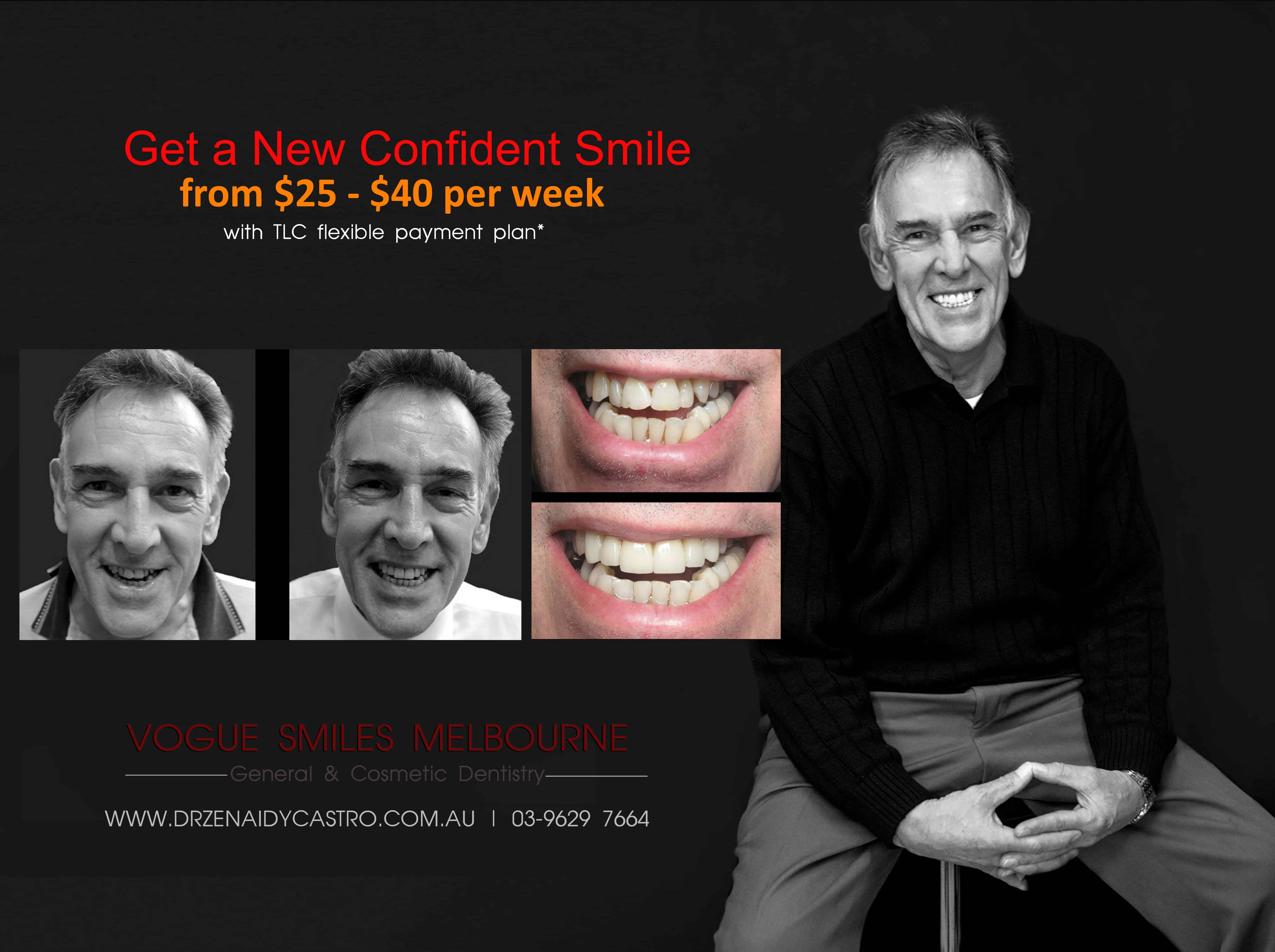 Melbourne's Best Veneers for Anti-aging | #1 Veneers Dentist Melbourne