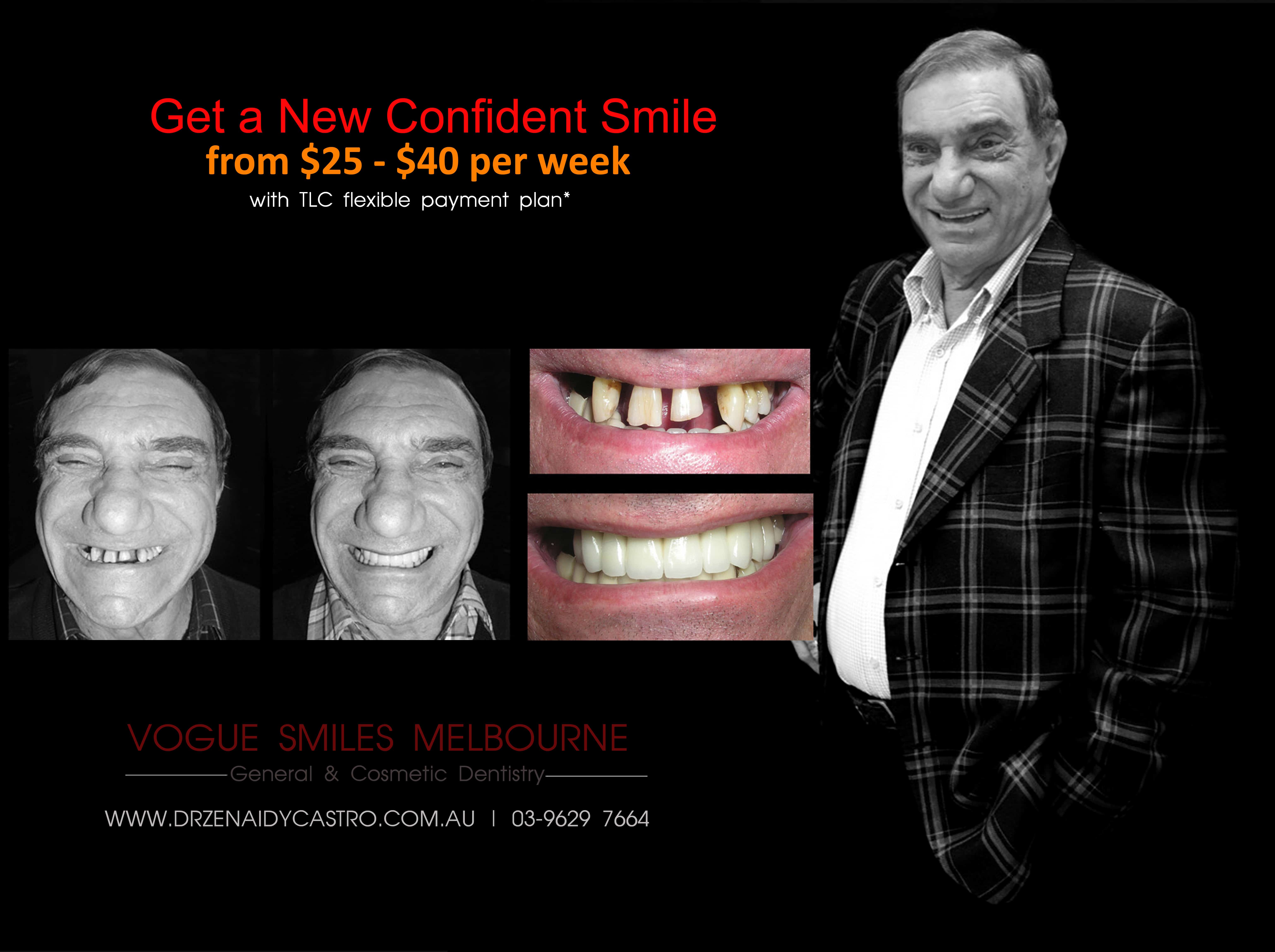 Smile Makeover Facelift Procedures in Melbourne | Non-Surgical Facelift with Porcelain Veneers