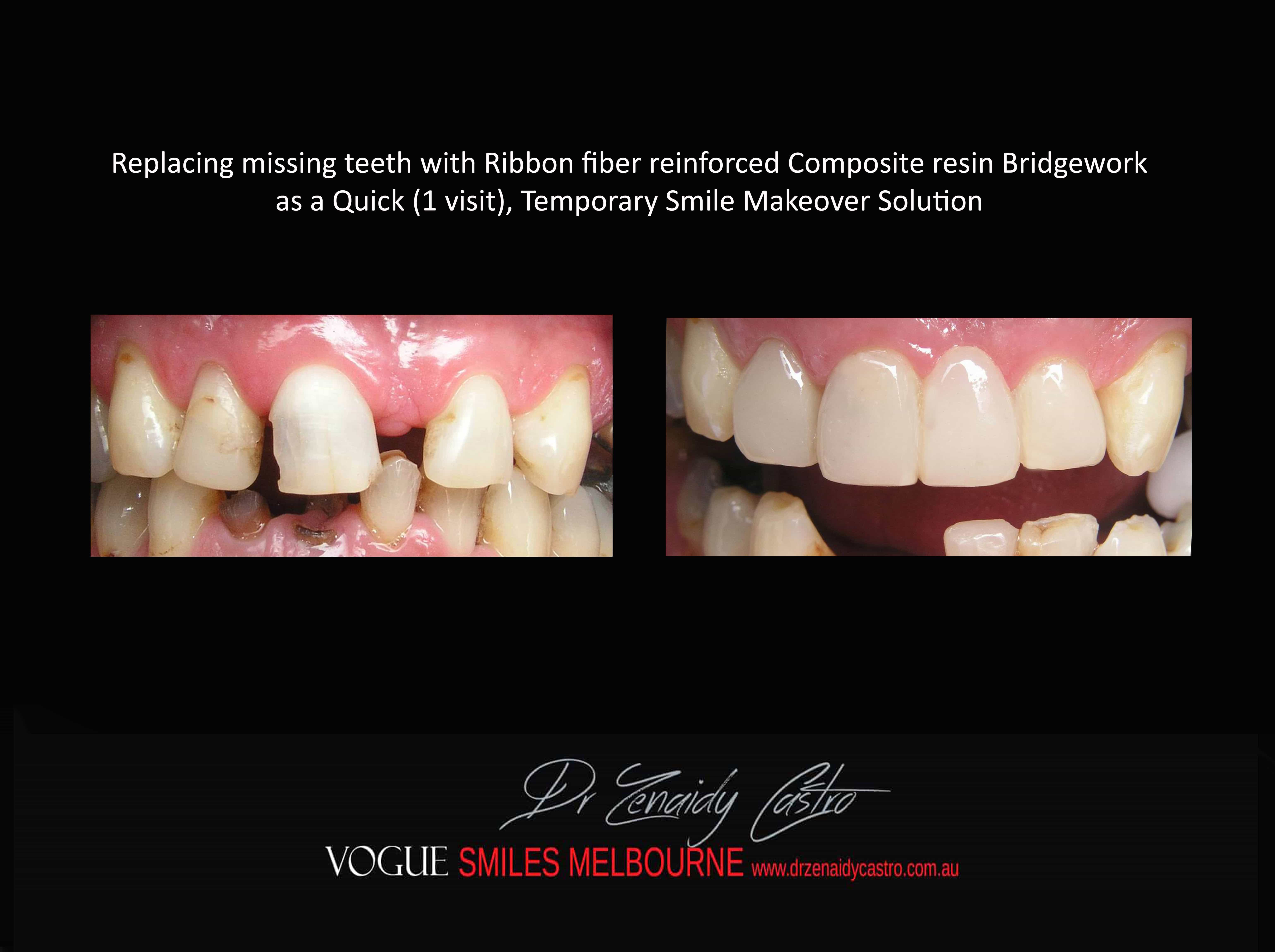  Instantly Replace Missing Tooth or teeth in Melbourne