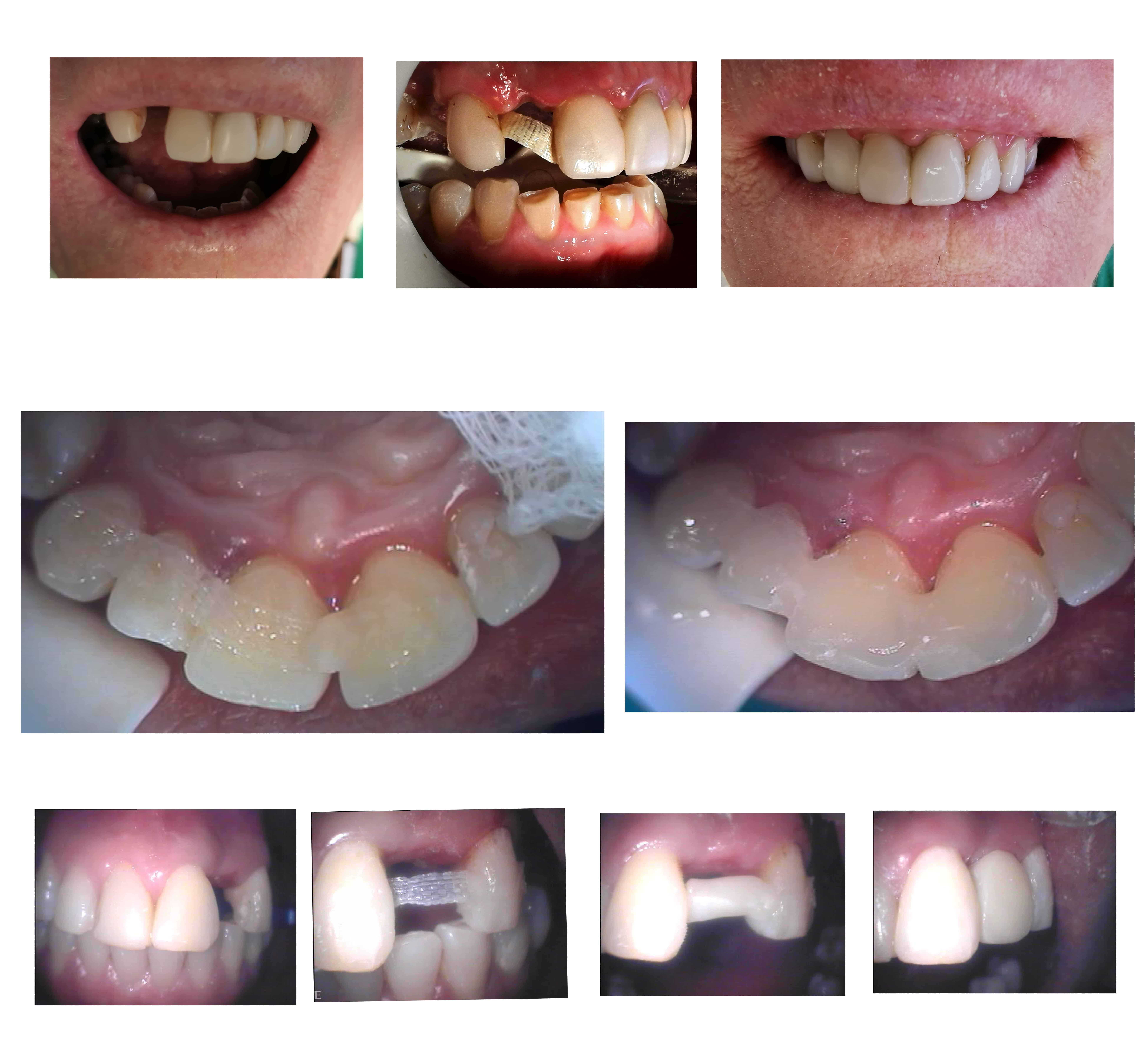 Least Expensive Smile Makeover option in Melbourne - cheapest way to improve smile 
