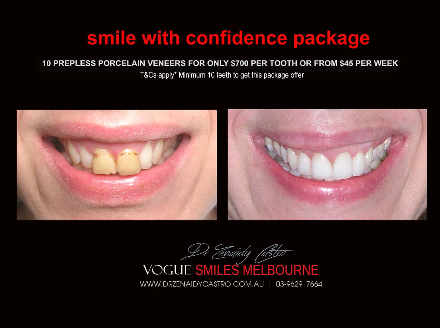 Porcelain Veneer for Discoloured Front Teeth Melbourne -Whiten Tooth Discolouration, Black Tooth, Dead Front tooth