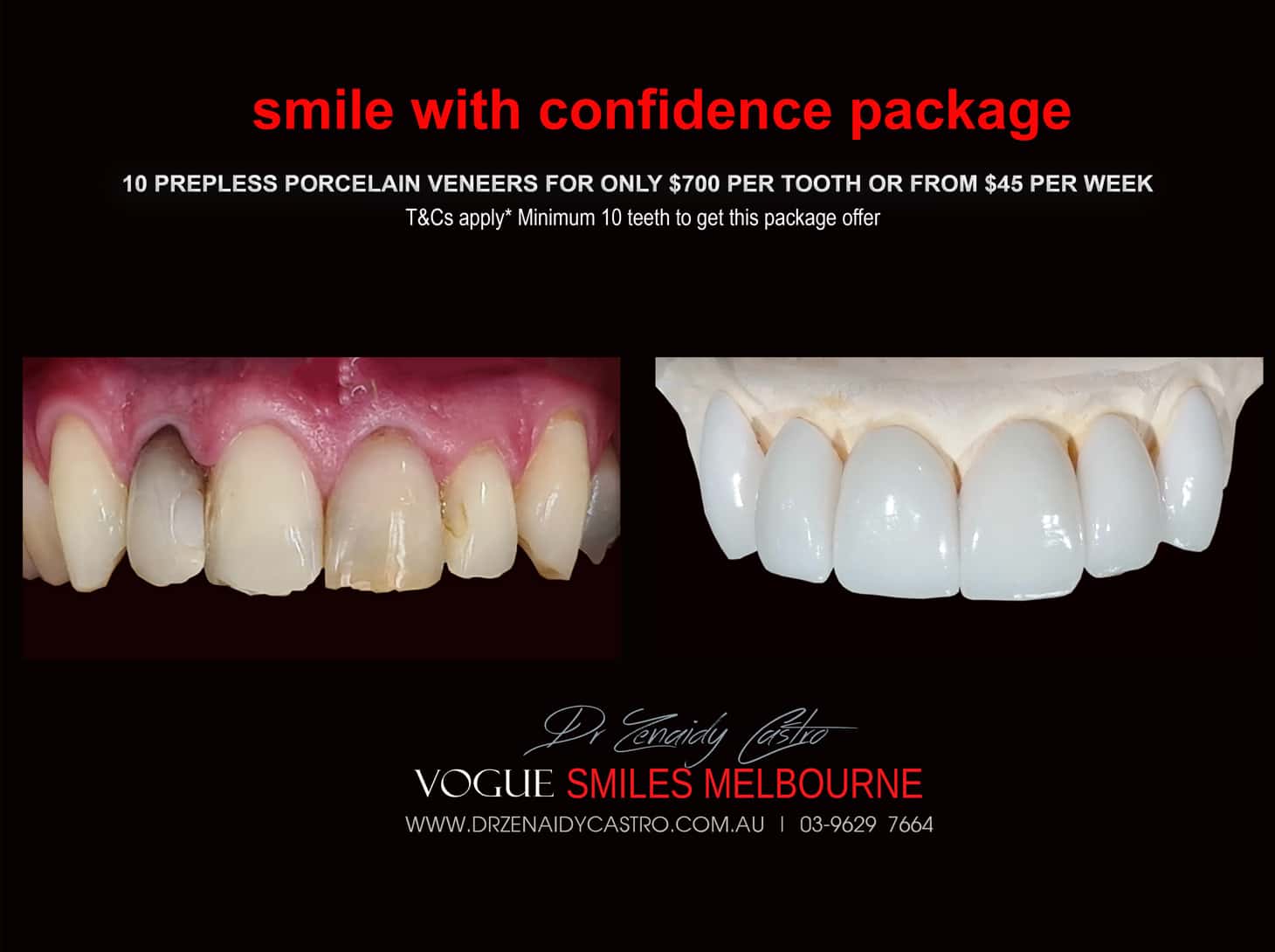 Porcelain Veneer for Discoloured Front Teeth Melbourne -Whiten Tooth Discolouration, Black Tooth, Dead Front tooth