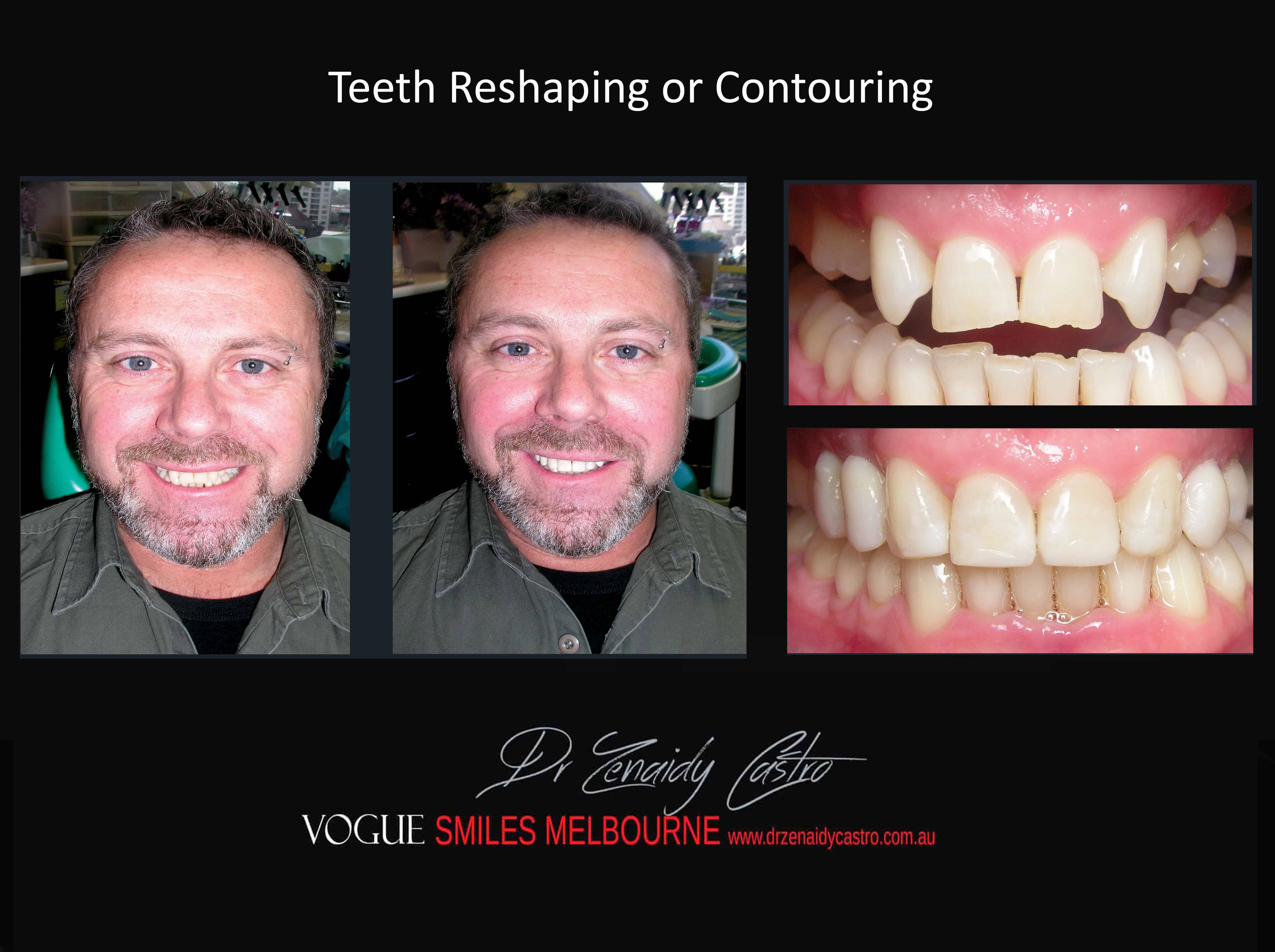 Teeth Reshaping and Contouring Melbourne