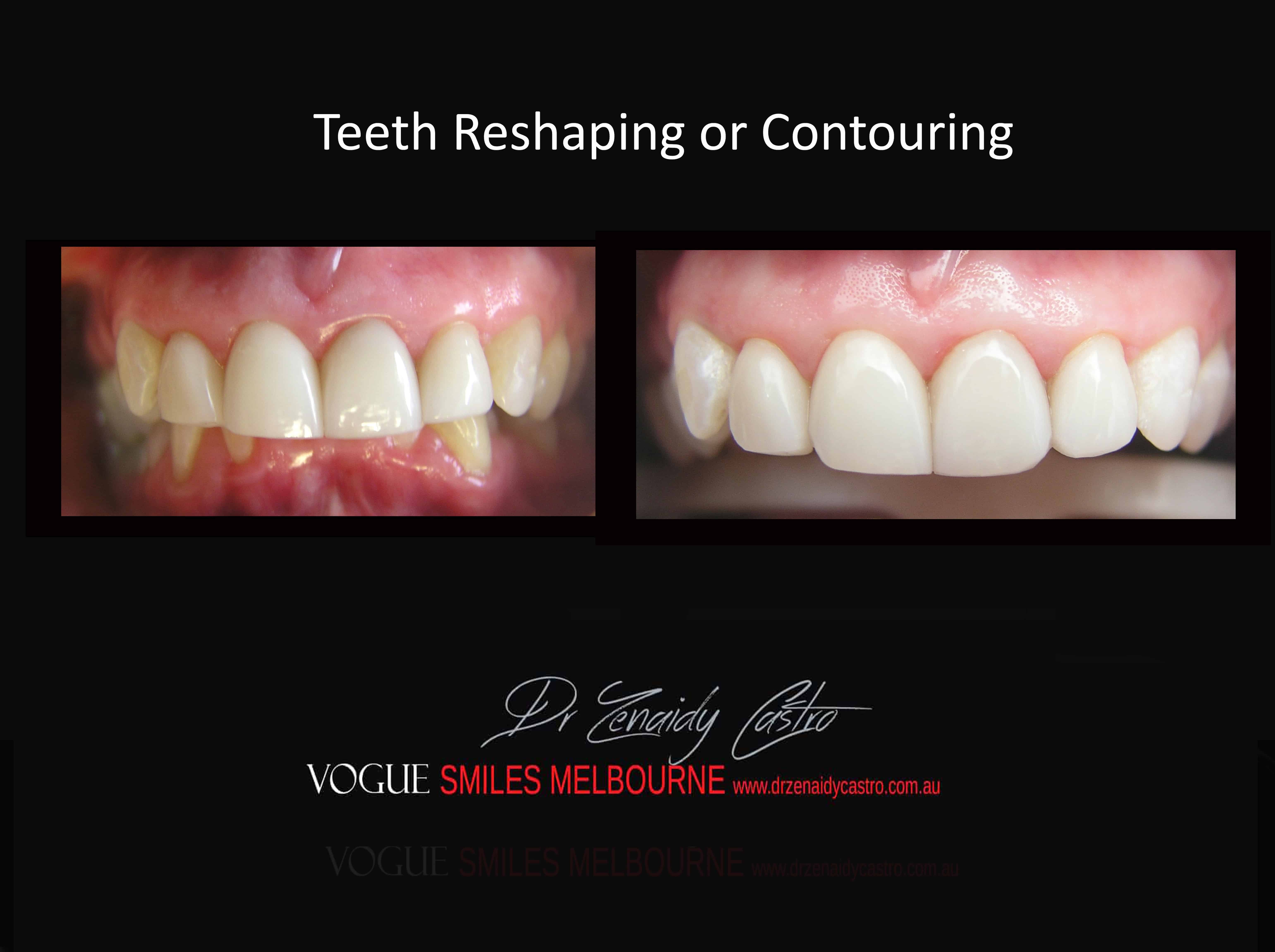 Teeth Reshaping and Contouring Melbourne