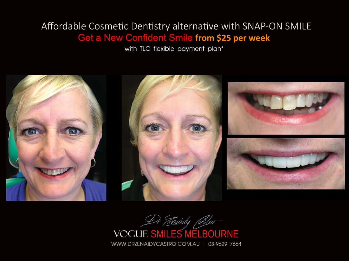 Anti-aging Dental Treatments Melbourne by best cosmetic dentist in Melbourne