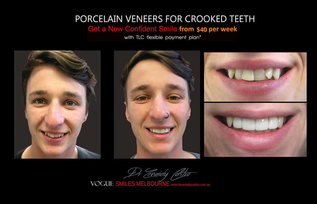 Porcelain Veneers for Crooked Teeth - Instantly Straighten Crooked Teeth without Braces 