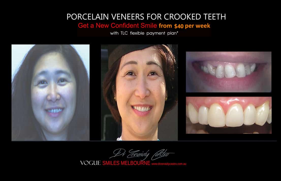 Porcelain Veneers for Crooked Teeth - Instantly Straighten Crooked Teeth without Braces 