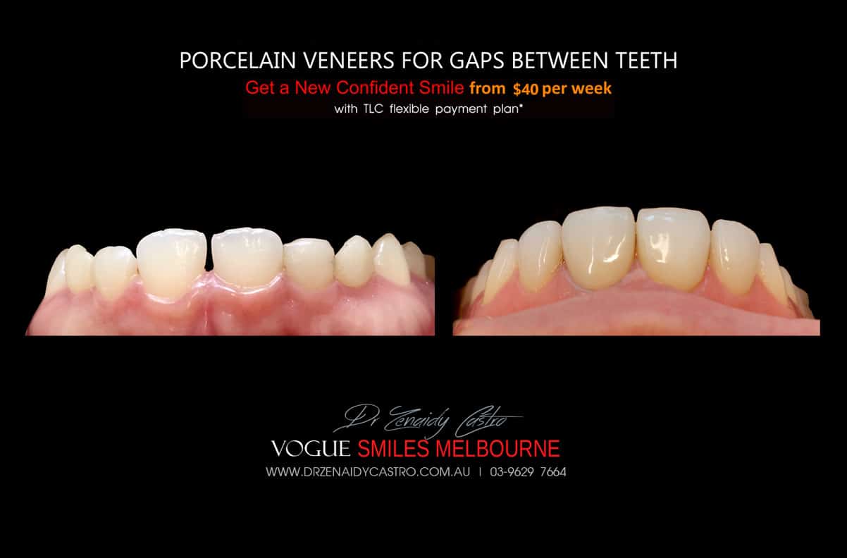 Porcelain Veneers for Gaps - Closing Spacing or Gaps in between Teeth Instantly w/o Braces Melbourne