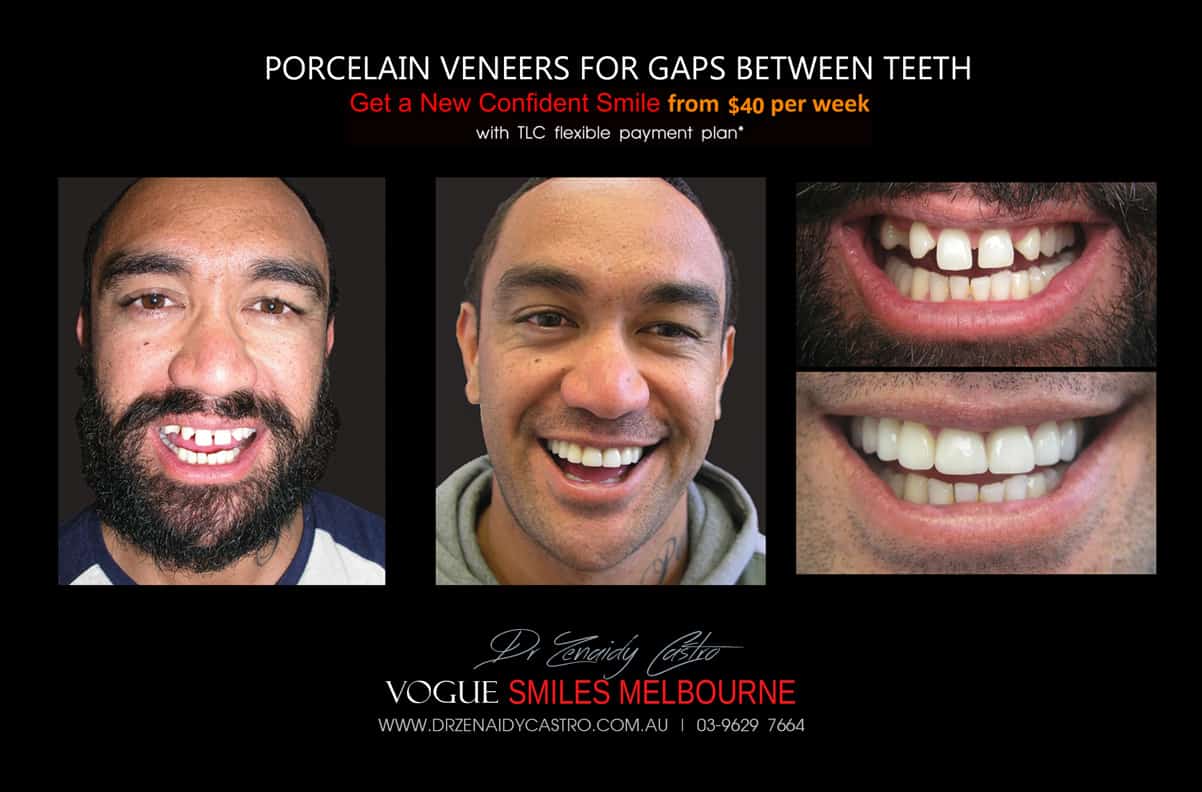 Porcelain Veneers for Gaps - Closing Spacing or Gaps in between Teeth Instantly w/o Braces Melbourne