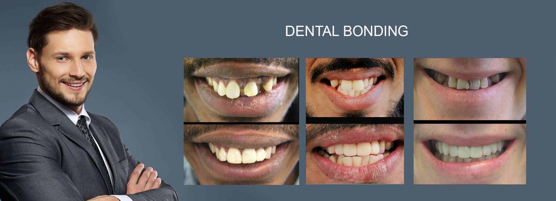 DENTAL BONDING Cosmetic Dentist Melbourne