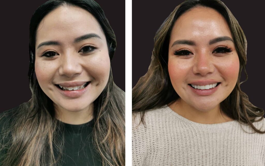 BEFORE AND AFTER SMILE MAKEOVER MELBOURNE 1