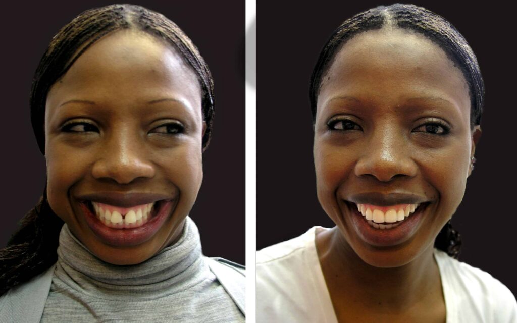 BEFORE AND AFTER SMILE MAKEOVER MELBOURNE 2