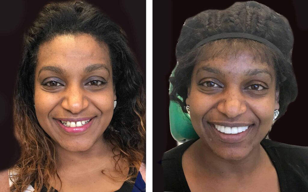 BEFORE AND AFTER SMILE MAKEOVER MELBOURNE 3