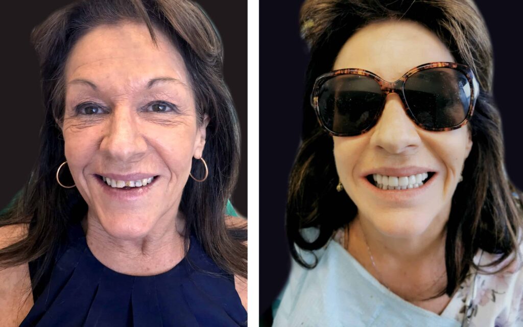 BEFORE AND AFTER SMILE MAKEOVER MELBOURNE 4