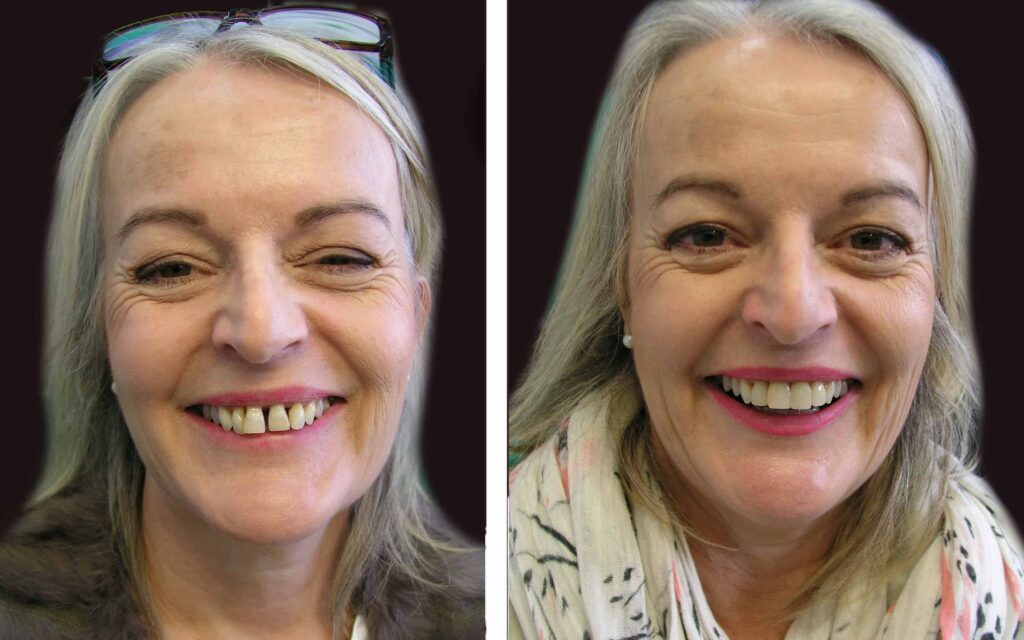 BEFORE AND AFTER SMILE MAKEOVER MELBOURNE 5