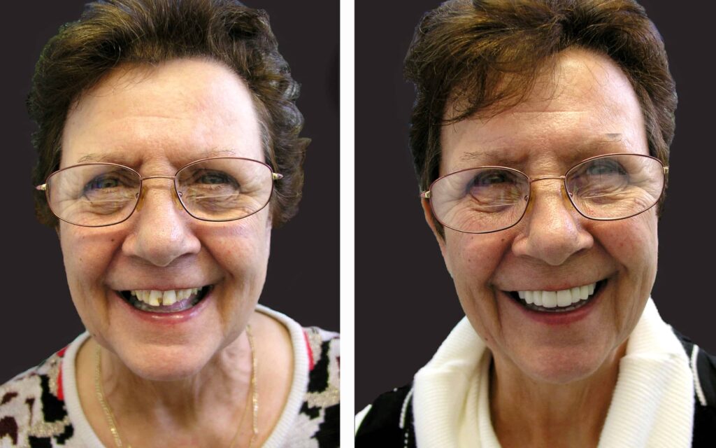 BEFORE AND AFTER SMILE MAKEOVER MELBOURNE 6